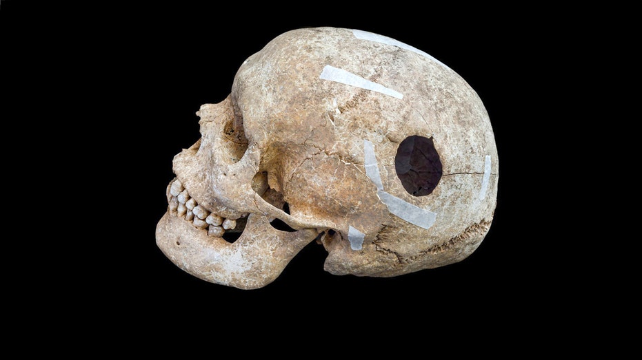 Archaeologists uncover evidence of early brain surgery on 9th-century man