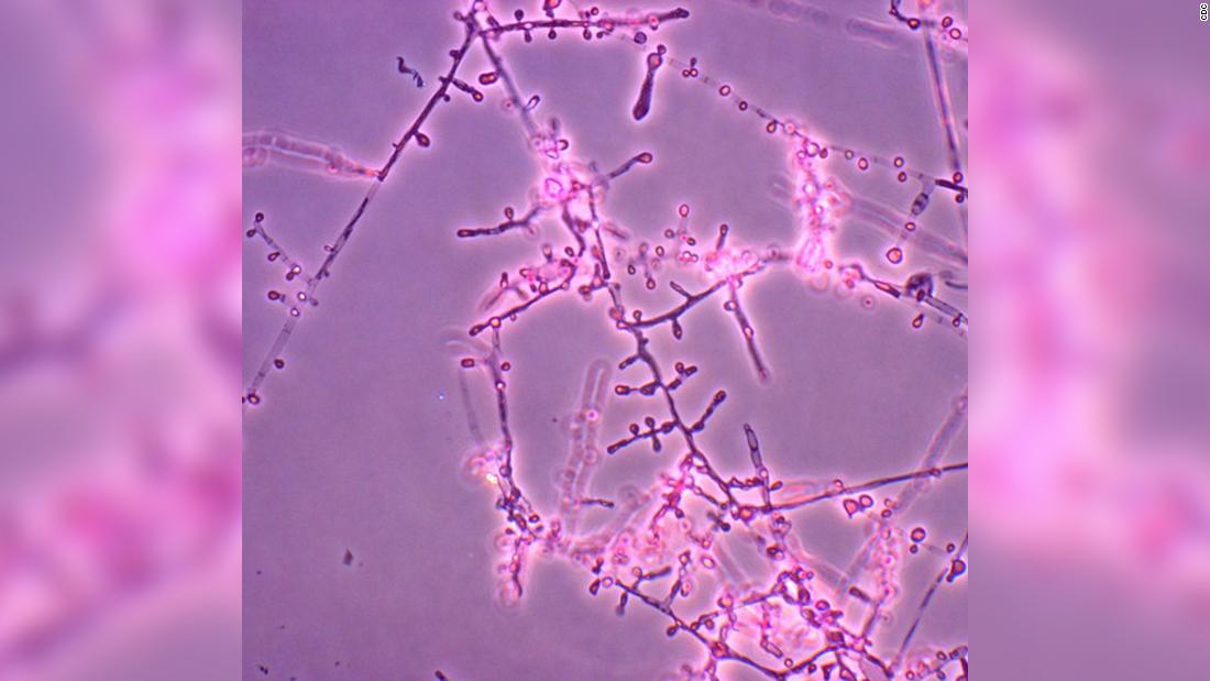 First US cases of treatment-resistant ringworm found in patients in New York City